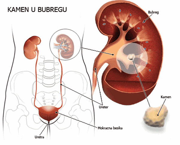 Uticaj ishrane na formiranje kamena u bubregu