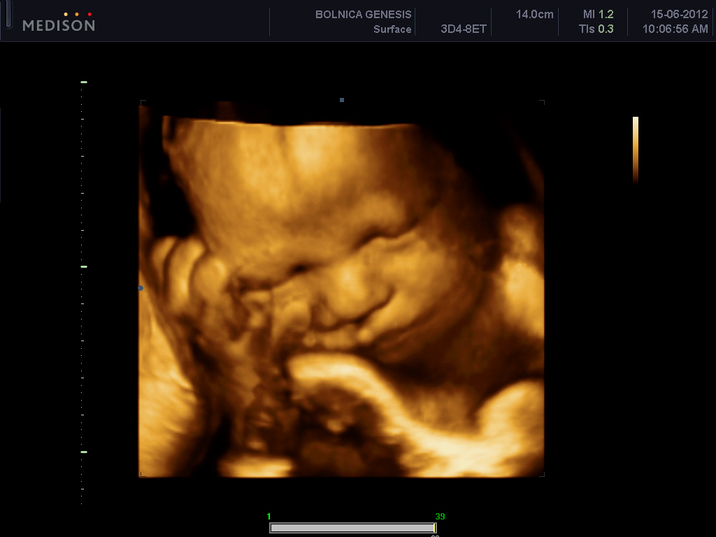 Ultrazvuk – udarac na zdravlje još nerođene dece