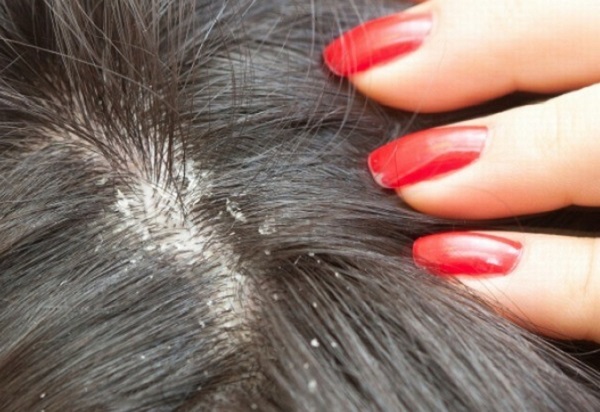 Napravite sami ulje protiv peruti