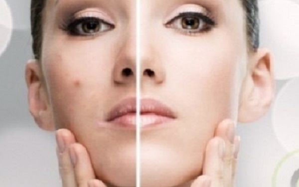 Kako ukloniti akne na licu