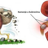 Metoda rastvaranja kamena u bubregu